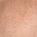 Dry Skin