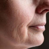 Dehydrated Skin