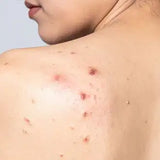 Body Acne